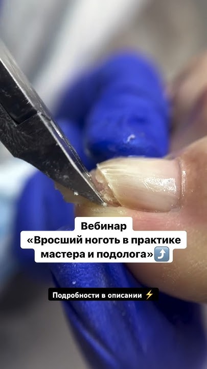 Научим правильно работать с вросшими ногтями! Подробнее про вебинар в ...
