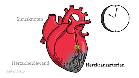 Was macht ein Herzschrittmacher bei Herzinfarkt?