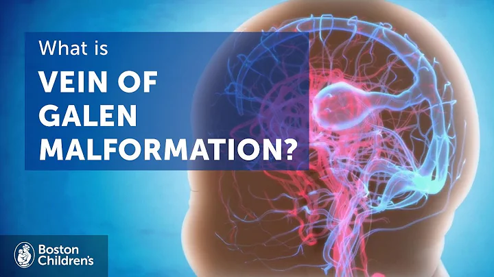Vein of Galen malformation (VOGM) | Boston Childre...