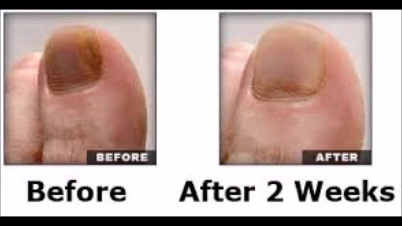 How Does Japanese Toenail Fungus Code Cure Japanese Toenail YouTube