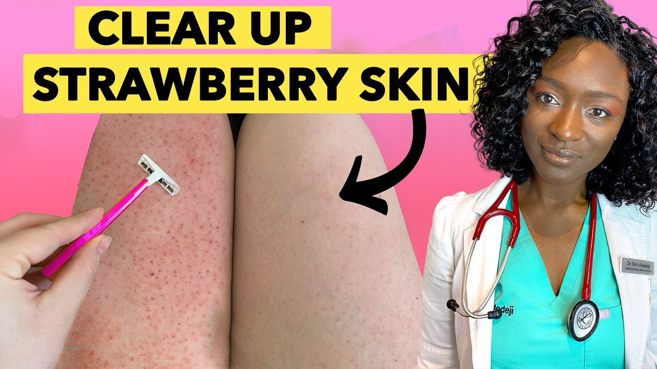 ???? Strawberry Legs - Why it Happens & How to Get Rid Of It - YouTube