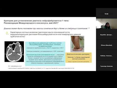 Нейрофиброматоз 1 типа:офтальмологическиепроявления/ Аубакирова Алуа Сауытбековна