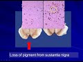 Pathology of Central Nervous System: Neurodegenerative Diseases