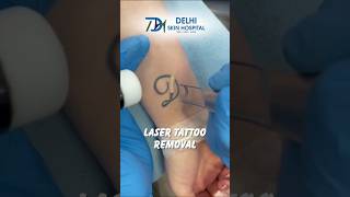 Say Goodbye to Unwanted ink with Laser Tattoo Removal