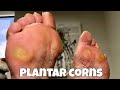 CORN REMOVAL FROM FEET - EXTREMELY SATISFYING