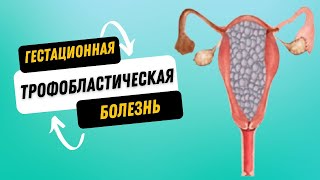 видео: ГЕСТАЦИОННАЯ ТРОФОБЛАСТИЧЕСКАЯ БОЛЕЗНЬ @DrOlenaB #беременность #пузырныйзанос #мольнаябеременность картинка: ГЕСТАЦИОННАЯ ТРОФОБЛАСТИЧЕСКАЯ БОЛЕЗНЬ @DrOlenaB #беременность #пузырныйзанос #мольнаябеременность