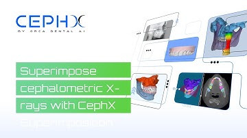 Superimpose cephalometric X rays with CephX  Superimposition