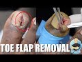 TOE FLAP REMOVAL OF FLESHY INGROWN TOENAIL