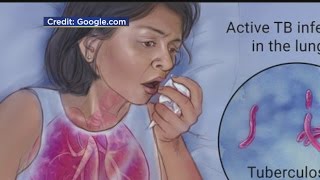 Tuberculosis Case Confirmed At Twin Cities School