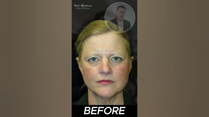 Brow And Eye Lift - 53 Years Old