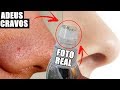 COMO REMOVER CRAVOS EM 1 MINUTO | MELHOR APARELHO DO MUNDO | DIVOS ENSINAM