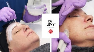 Microdermabrasion With Dr Levy The Laser And Skin Clinic