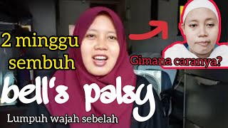 Pengalaman Bell's palsy (lumpuh wajah sebelah) sembuh dalam 2 Minggu bagaimana caranya?