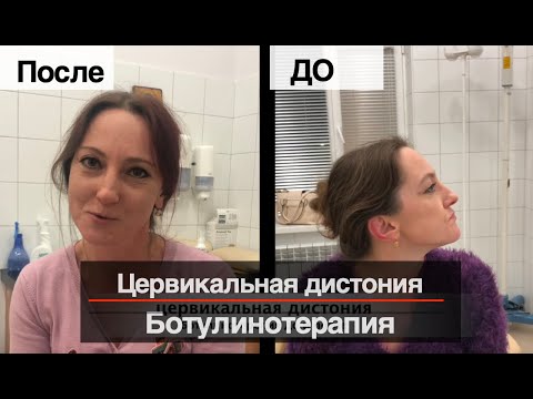 Цервикальная дистония (Спастическая кривошея), БОТУЛИНОТЕРАПИЯ ! ДО и После!