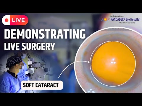Small pupil mature cataract Dr Sourabh D Patwardhan 3D live Phaco surgery.