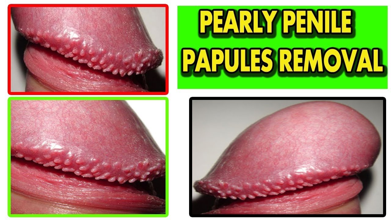 pearly penile papules homeopathic remedy, pearly penile papules treat...