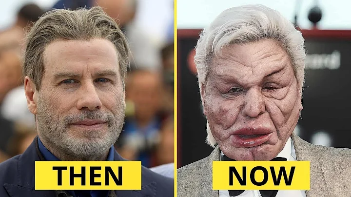 20 Celebrity Plastic Surgery Disasters That Forced Them Out of The Limelight | Then and Now 2025