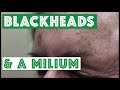 Blackheads and a Milium