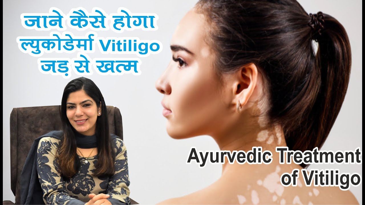 ल्युकोडेर्मा / Vitiligoका आयुर्वेदिक इलाज Treating Leucoderma