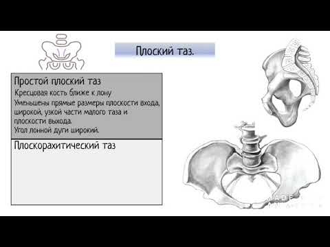 Узкий таз