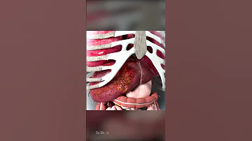 Liver Cancer Symptoms That Are Often Overlooked 