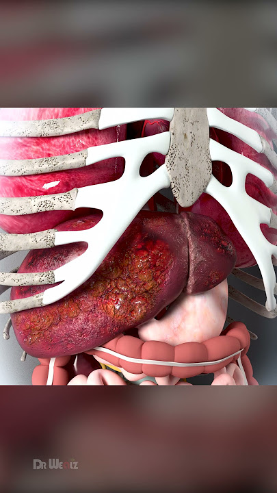 Liver Cancer Symptoms That are Often Overlooked