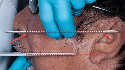 Chairside Live Episode 263: Achieving Wax Rim Try-In Success