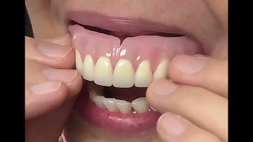 Finished Denture in the Mouth