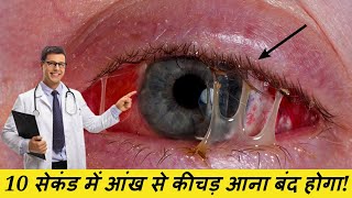 जानिए आंख से कीचड़ आना किन बीमारियों का है संकेत और इलाज| Eye Care Tips In Hindi