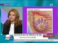 Factorii de risc în ceea ce privește cancerul mamar - Emisiunea Trăiește Sănătos/ Antena 2