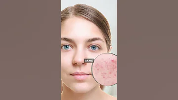 Чем ОПАСЕН дефицит витамина Д? #витамины #дефицит #здоровье
