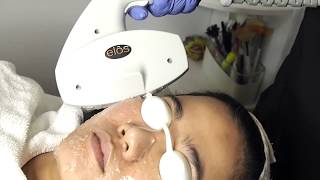 How Is IPL Photofacial Intense Pulse Light Treatment Done How Is IPL Photofacial Intense Pulse Light Treatment Done