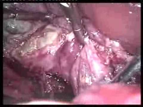 Laparoscopic Videos (edited-4)- Lap Chole Acute Cholecystitis After 7 Days