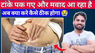 tanke pakne par kya kare | टांके पकने पर क्या करे | tanke pak jaye to kya kare | ghaw se mawad aana