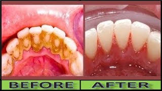 Take your teeth into own hands (or should i say mouth) and whiten them
naturally using this diy activated charcoal toothpaste recipe.
mail:-kotipalli757...
