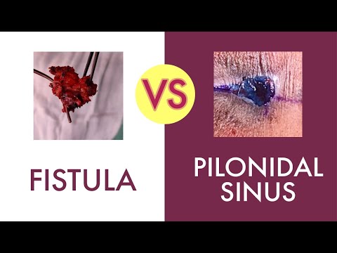 PILONIDAL SINUS vs FISTULA IN ANO