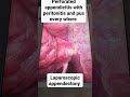 Thanks laproscopy، One more patient saved from a major laparotomy۔