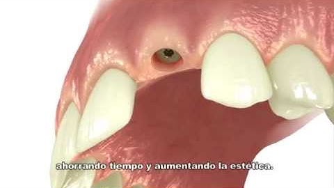 One Abutment One Time™