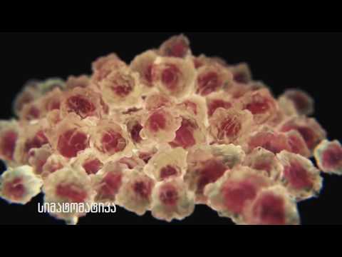 როგორ ვითარდება სიმსივნე