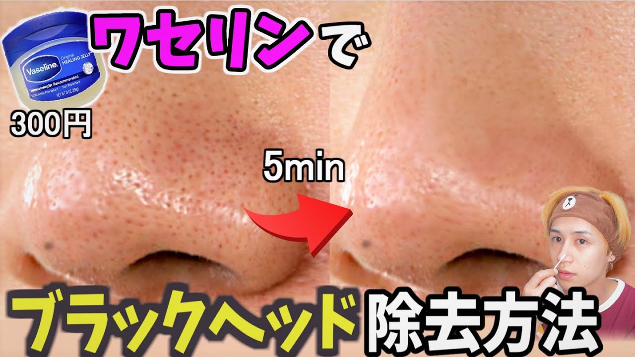 ワセリンを使って5分で毛穴ブラックヘッドを無くす方法 Black Head Remover Vaseline Youtube