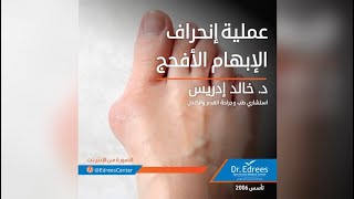 عملية انحراف الإبهام الأفحج د. خالد إدريس إستشاري طب وجراحة القدم والكاحل