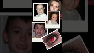 Why Eyes Glowed Red in Old Photos 📸 | Science Behind Red-Eye Effect #eyescience #retinitis
