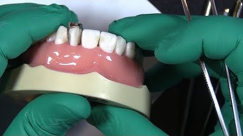 Placing two fusion anterior matrix bands on a single tooth