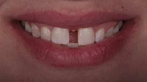 Wie entsteht ein Diastema?