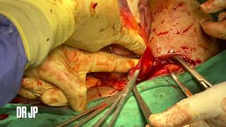 Placenta Accreta-Cesarean Hysterectomy