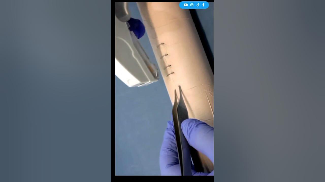 Surgical staples placing removing surgical wound closure staples