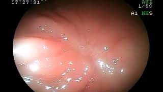 28062019 Colonoscopy Three Month After Emr