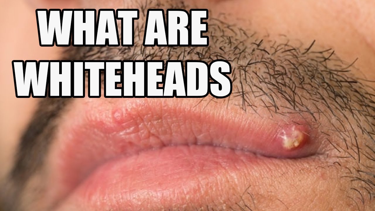 How To Get Rid Of Big Whiteheads On Face