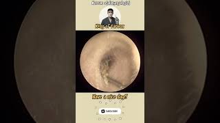 @귀지형 #귀지#귀지제거 #귀파기 #귀파기asmr  #귀청소 #이비인후과 #earwax #earwaxremoval  #asmr #ENT #ENTdoctor