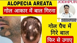 सिर में दाढ़ी में गोल सिक्के के आकार में बाल गिरने का इलाज । Alopecia areata permanent treatment ।